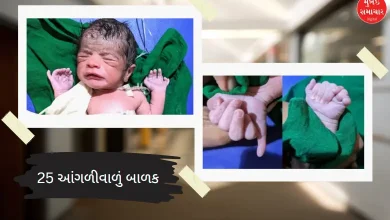 A child has been born in a district of Karnataka, who has a total of 25 fingers