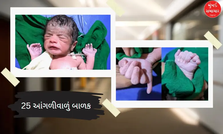 A child has been born in a district of Karnataka, who has a total of 25 fingers