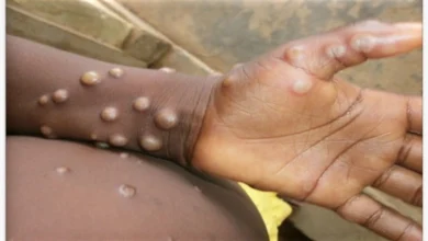 The Serum Institute of India will make monkeypox vaccine