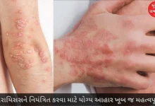 Psoriasis sufferers should not eat this food by mistake, otherwise