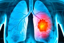 Lifestyle: Whether you have lung cancer or not, do the test at home like this...