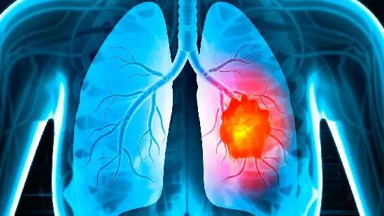 Lifestyle: Whether you have lung cancer or not, do the test at home like this...