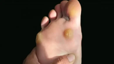 Remedies for Foot Corn