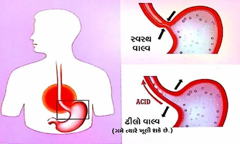 Health Plus These are the symptoms of acidity