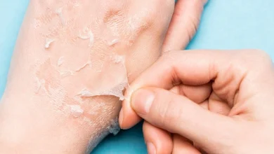 Does the skin start peeling off from the hands in winter? Then try these remedies