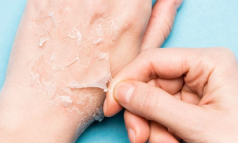 Does the skin start peeling off from the hands in winter? Then try these remedies