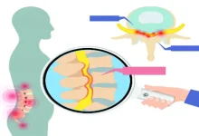 "Diagram of muscle contraction due to stenosis condition"