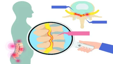 "Diagram of muscle contraction due to stenosis condition"