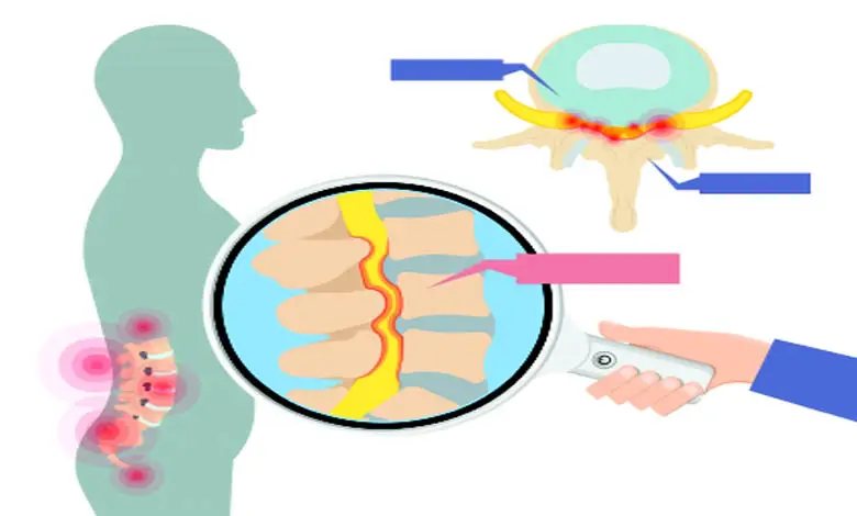 "Diagram of muscle contraction due to stenosis condition"