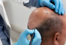 Read this before undergoing a treatment like hair transplant: Two people lost their lives in Kanpur