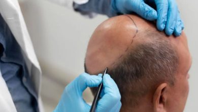 Read this before undergoing a treatment like hair transplant: Two people lost their lives in Kanpur