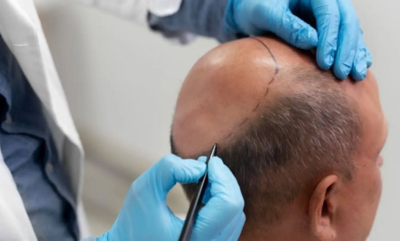Read this before undergoing a treatment like hair transplant: Two people lost their lives in Kanpur