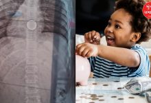 A 10-year-old girl swallowed a coin in Valsad, her life was saved, parents beware!