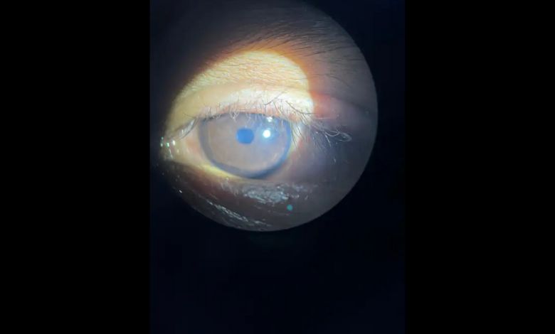 "Lice in Eyelashes: Rare Case in 8-Year-Old Child Reported"