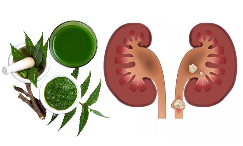 આ ઔષધિ તમારી પથરીને જડમૂળથી દૂર કરશે