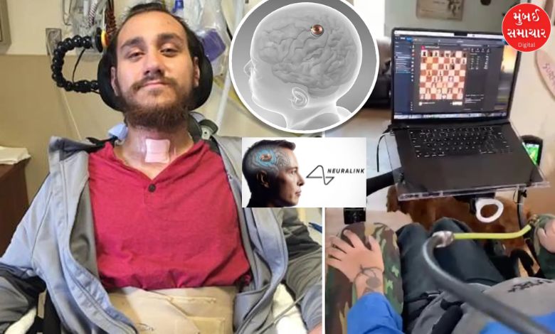 Neuralink miracle: Paralyzed patients move computer cursor with brain power after 20 years