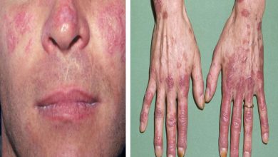 A disease that is a mysterious enemy of the home: Lupus