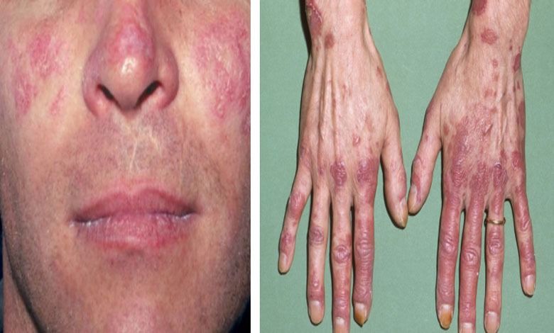 A disease that is a mysterious enemy of the home: Lupus
