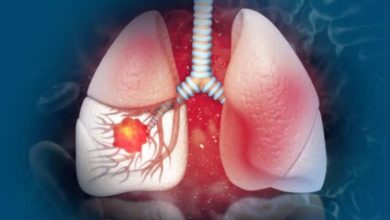 Did you know that even if you are not addicted to smoking, the sword of lung cancer hangs over you...