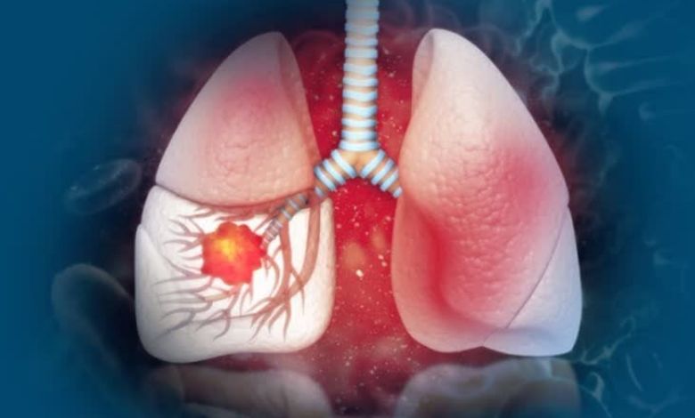Did you know that even if you are not addicted to smoking, the sword of lung cancer hangs over you...