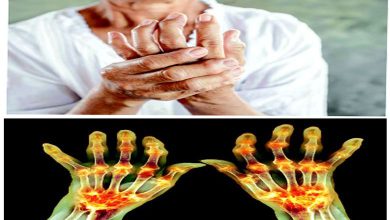 Health Express: Rheumatoid arthritis: A joint disease that can strike at any age