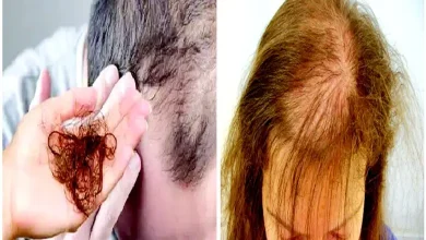 Health Express: A disease that robs the beauty of hair: Alopecia areata