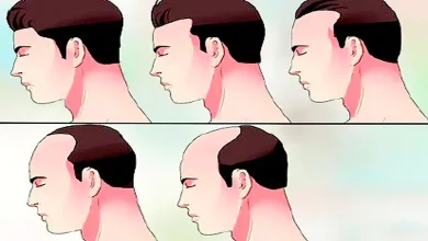 Generation Z men losing their hair prematurely