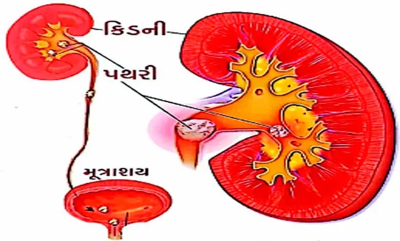 What is a stone? Health Plus