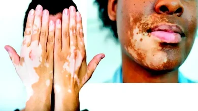 Health Express: Vitiligo, a disease that changes skin color