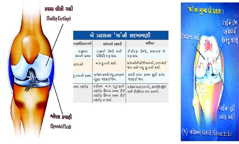 વાના દુખાવામાં રાહત માટેના ઘરેલું ઉપચાર અને સાંધાનો ઘસારો