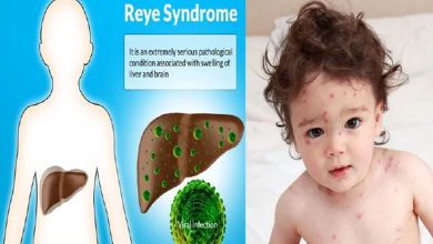 Health Express: What is this 'Rey' syndrome?