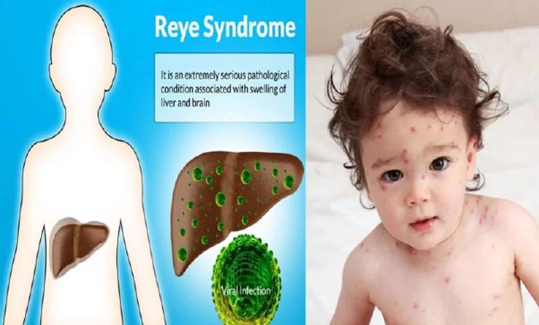 Health Express: What is this 'Rey' syndrome?