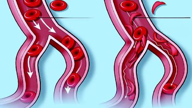આરોગ્ય એક્સપ્રેસઃ લોહીનો વારસાગત રોગ સિકલ સેલ...