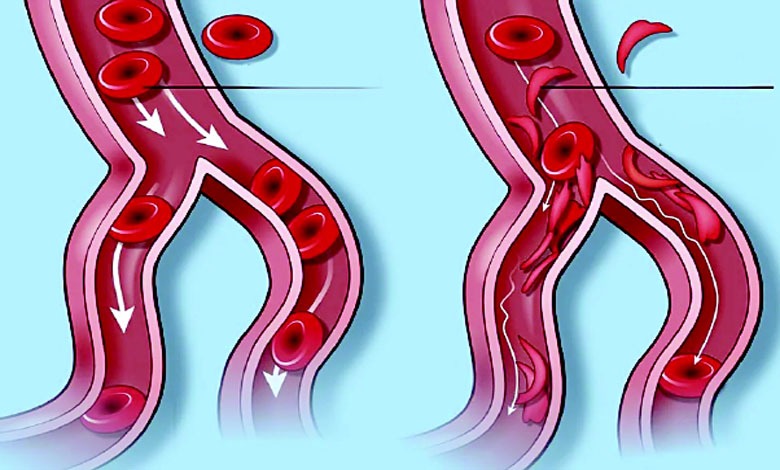 આરોગ્ય એક્સપ્રેસઃ લોહીનો વારસાગત રોગ સિકલ સેલ...
