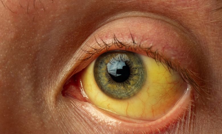 Health officials investigate the sudden rise of 126 jaundice cases reported in Balasinor town, raising fears of a possible outbreak.