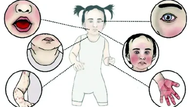 ૫ વર્ષથી નાનાં બાળકોમાં જોવા મળતો કાવાસાકી રોગ અને તેનાં લક્ષણો, રક્તવાહિનીઓમાં સોજો