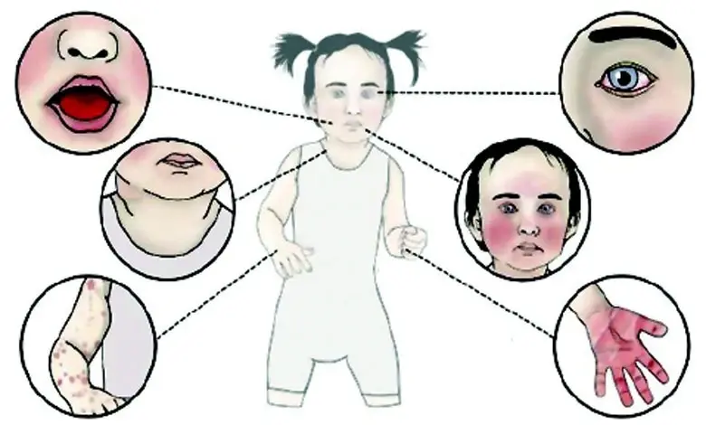 ૫ વર્ષથી નાનાં બાળકોમાં જોવા મળતો કાવાસાકી રોગ અને તેનાં લક્ષણો, રક્તવાહિનીઓમાં સોજો