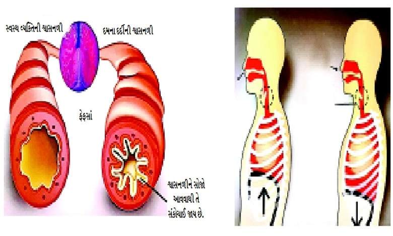 દમ (અસ્થમા) ના લક્ષણો અને આયુર્વેદિક ઉપચાર દર્શાવતો ફોટો