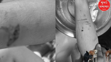 Dog terror in Surat: 5 dogs attacked an innocent child, he had to get 35 stitches on his head and body!